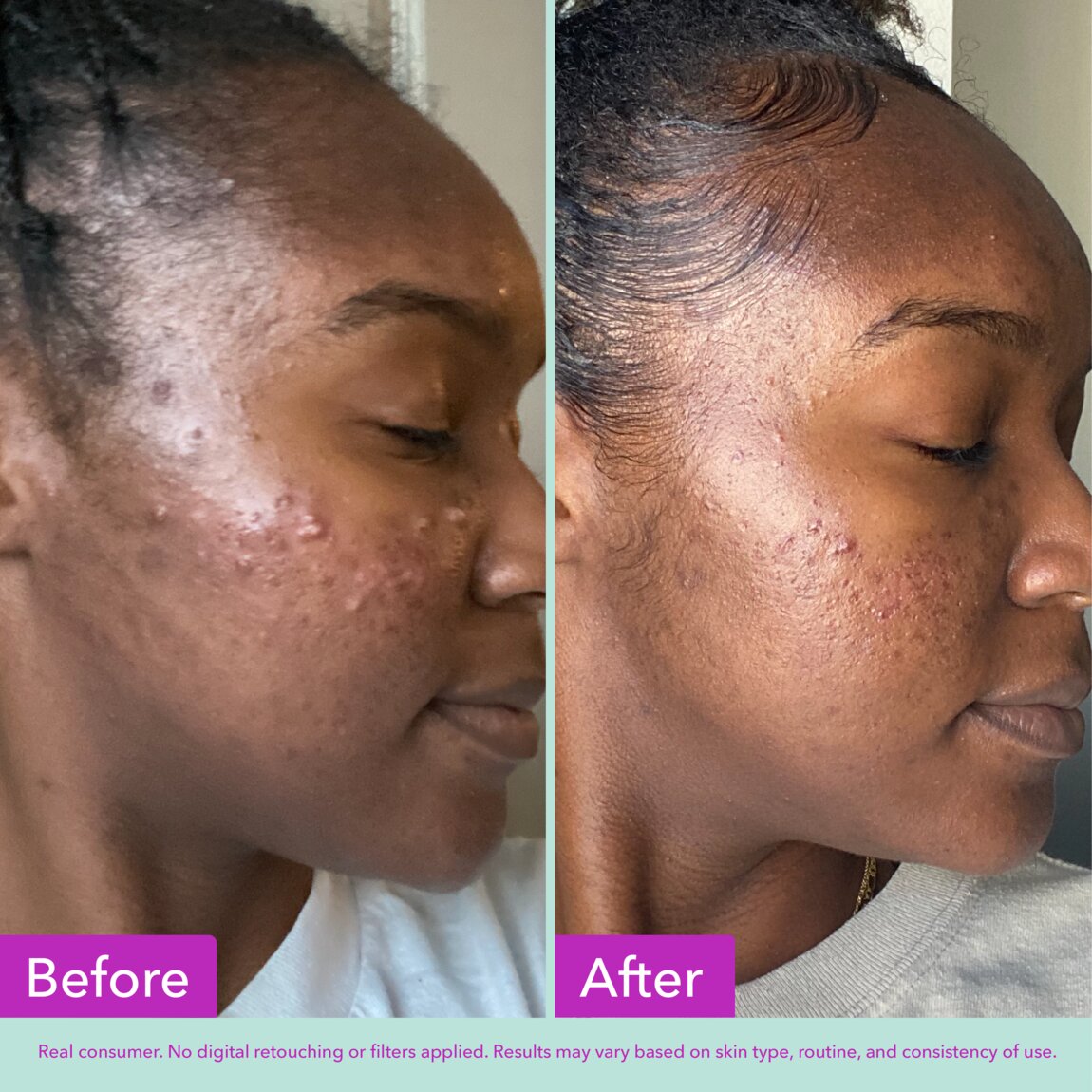 acne-foaming-cleanser-t0 zb_p.jpg